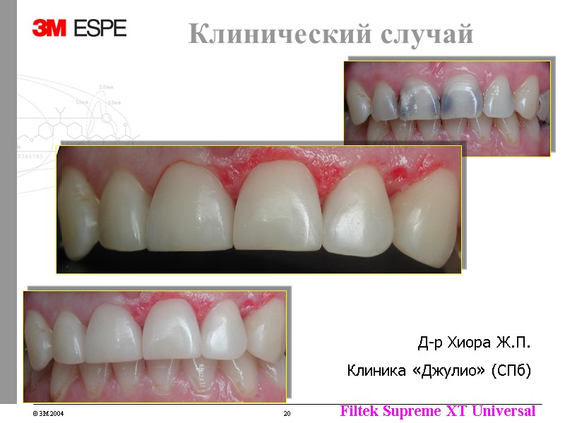 Клинический случай Д-р Хиора Ж.П. Клиника «Джулио» (СПб) Клинический случай Д-р Хиора Ж.П. Клиника «Джулио» (СПб)